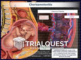 Image result for Chorioamnionitis