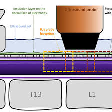 Experimental Configuration. A standard octal lead placed midline...