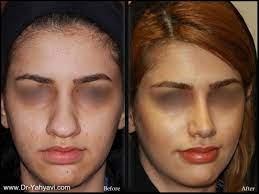 Thick Skin Noses (Meaty Noses) - Dr. Shahriyar Yahyavi