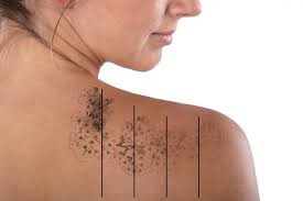 How does laser tattoo removal work? Laser Tattoo Removal Perth Safe Painless Dr Robert Goldman