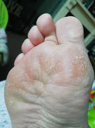 Sole of feet problem (picture) | Diabetes Forum