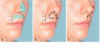 Figure 7 From The No Scar Lip Lift Upper Lip Suspension Technique Semantic Scholar Upper Lip Lip Surgery Lips