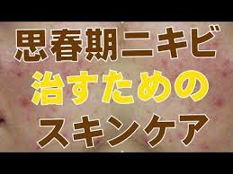 美容 思春期ニキビの治し方教えます エステティシャンが教えるスキンケア youtube ニキビ 美容 ニキビケア