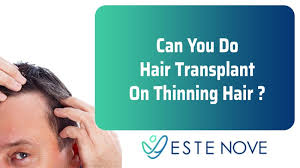 And illnesses such as cancer and. Can You Do Hair Transplant On Thinning Hair Estenove Hair Transplant