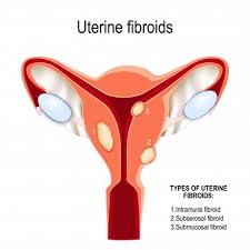 Uterine fibroids are extremely common in women of childbearing age and usually regress after menopause. Uterine Fibroids Professor Andreas Obermair