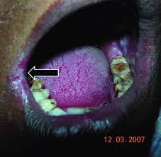Image result for Angular Stomatitis