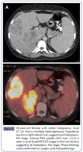 What do you consider as processed meat? Comparison Of Contrast Enhanced Mdct And Integrated Fdg Pet Ct Staging Of Colorectal Cancer Insight Medical Publishing