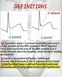 Image result for Early Repolarization
