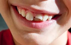 نصائح لكيفية التعامل مع الاسنان المكسورة المرسال