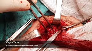 Dec 31, 2011 · mckeown's ideas of essentialism are based on absolutely stunning approaches to life and work, which are now reused and retold in so many books, methodologies and techniques. Mckeown Procedure For Esophageal Cancer Cervical Anastomosis Youtube