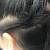 Lice Eggs In Hair Vs Dandruff
