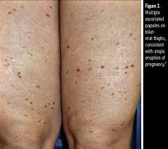 Image result for pruritic urticarial papules and plaques of pregnancy