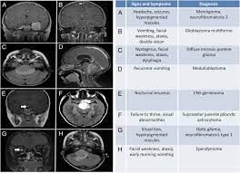 Increased pressure can lead to general symptoms such as: Childhood Brain Tumors American Academy Of Pediatrics