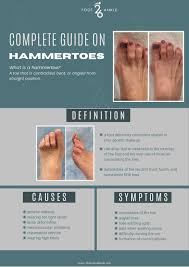 Image result for Hammer toe