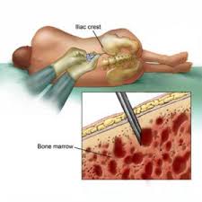 Myeloproliferative disorders begin in the bone marrow and may cause a greater than normal number of stem cells to develop into one or more types of blood cells. Bone Marrow Transplant Cancer Treatments At Low Price Bone Marrow Treatment In India Treataid