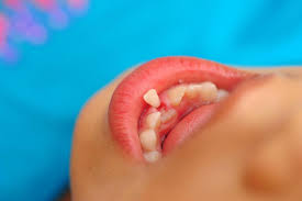 How To Deal With Your Child S Knocked Out Tooth Ek Dental Surgery