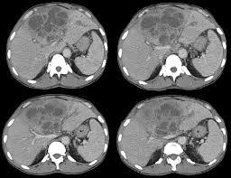 Image result for Liver Abscess