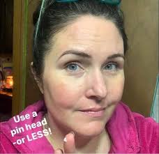 So I've been getting bad acne