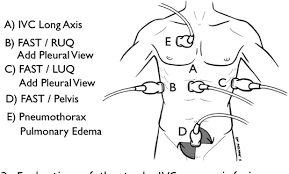 Ophthalmologists at rush are committed to correcting, restoring or maintaining your vision. Figure 7 From The Rush Exam Rapid Ultrasound In Shock In The Evaluation Of The Critically Lll Semantic Scholar