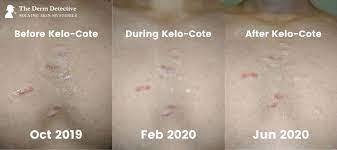 The best creams for healing scars contain ingredients that effectively reduce the. The 10 Best Scar Gels With Before After Pics 2021 The Derm Detective