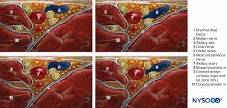 Image result for Axillary Nerve Block
