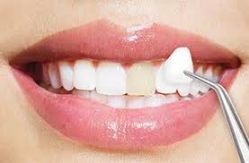 Veneer gigi ini yang langsung dikerjakan dan dibentuk di gigi kamu dengan menggunakan bahan. Cara Merawat Veneer Agar Tetap Bagus Dan Tahan Lama Dentalosophy