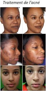 Pin On Soins Visage