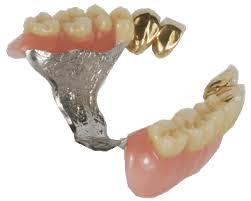 Die cover denture prothese ist eine sonderform des kombinierten zahnersatzes und wird auch als auch hybridprothese oder deckprothese genannt. Prothese Pflege Prothesenreinigung Pflege Handhabung Putzen
