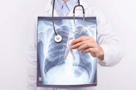 How Long Can You Live With Stage 4 Cancer Without Treatment Lung Cancer Lawsuit Lawyers Pintas Mullins Law Firm