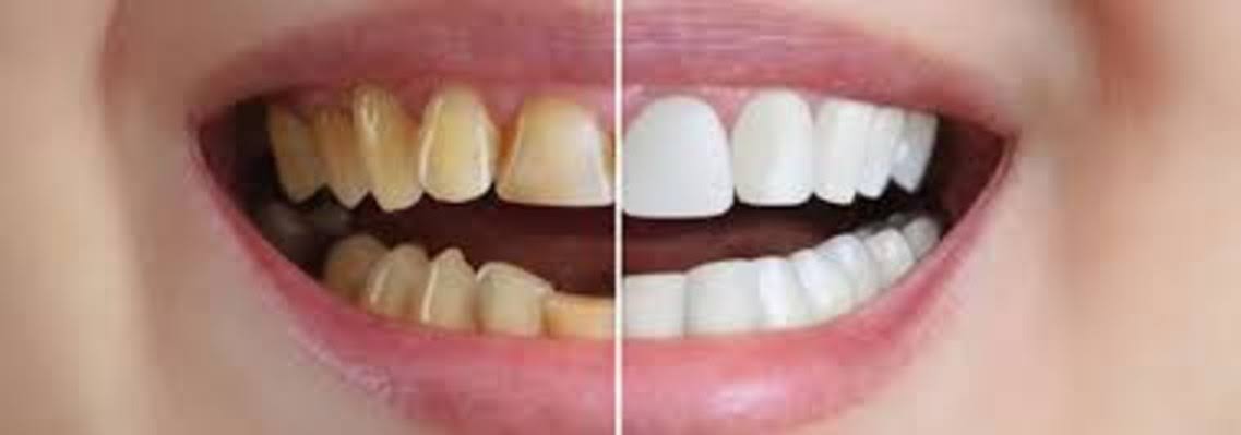 Full Mouth rehabilitation product image