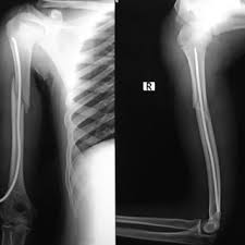 Not only is the place extremely clean but their dip powder. Pdf Treatment Of Humeral Shaft Fracture By Single Elastic Stable Intramedullary Nail In Chidren