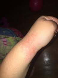 Heat Rash Or Prickly Heat Is A Condition That Is Caused When Clothing Our Skin Is Restricting Sweat From Being Released From The Heat Rash Prickly Heat Skin
