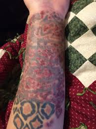 Laser tattoo removal would be the best options for you. Tattoo Laser Removal After Photo Laser Tattoo Laser Removal Laser Tattoo Removal