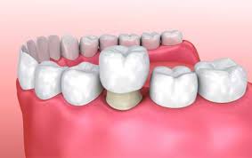 Nov 04, 2020 · the expenses will also depend upon the kind of bridge that you pick: Dental Crown And Dental Bridges Cost Zirconia Crowns Ceramic Crowns
