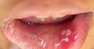 —how do i know if my partner has an hpv infection? Hpv In The Mouth Symptoms Causes And Treatment