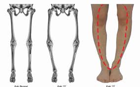 Kelainan kaki berbentuk x juga dapat disebabkan oleh kelainan genetik. Penyebab Kaki O Atau Bowlegs Dan Treatment Yang Tepat Klinik Tulang Belakang