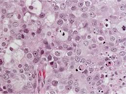 Even if the cancer spreads or improves, it will still be referred to by the stage at which it was diagnosed. Staging Grade Breast Pathology Johns Hopkins Pathology