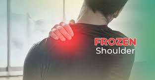 Image result for Frozen Shoulder