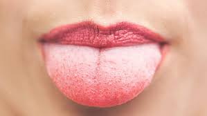 Maybe you would like to learn more about one of these? 8 Penyebab Sering Sariawan Di Lidah Yang Jarang Diketahui Hot Liputan6 Com