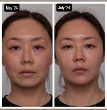 27 yo David Kosir has made the news recently, who began with  #medicalaesthetics in 2019, going for an exaggerated Ken doll look, only to  discover recently he didn't like it and dissolving