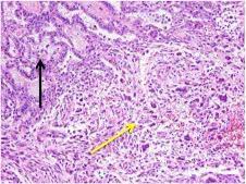 And cytoplasmic tonofilaments, favouring the diagnosis of mesothelioma (figure 2). Mesothelioma Oncology Medbullets Step 1