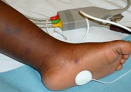 Mottled skin refers to the appearance of the skin when there is a patchy discolouration to it. Meningitis Symptoms In Babies Meningitis Research Foundation