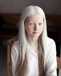 Albino Heterochromia Female Unknown Name Irtr Beautifulfemales Albino Girl Albinism Portrait