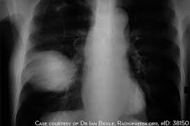 Smoking can also irritate the lungs and cause a short term cough. Hyponatremia As A Survival Predictor For Lung Cancer
