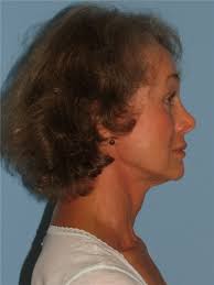 Facelift Before and After Photos by Paul Vanek, MD, FACS; Concord, OH