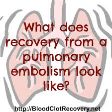 Welcome to nascar's official fan page! What Recovery From A Pulmonary Embolism Looks Like Blood Clot Recovery Network