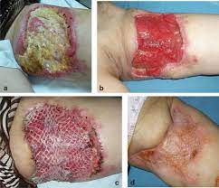 Split Thickness Skin Grafts Intechopen