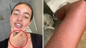 Perth girl's sunburn lands her in hospital as health expert warns of  surging cases