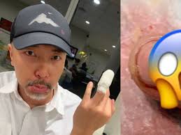 Tay Ping Hui Crushed His Finger Real Badly On Set; Says The Pain Was A  “Perfect 10”
