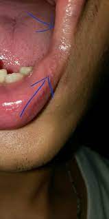 Jika kulit bibir memiliki ruam, menyerupai semolina atau butiran kecil dengan ukuran tidak lebih dari 3 mm, maka pasti itu adalah penyakit.itu tidak mewakili bahaya dan tidak mempengaruhi tubuh secara keseluruhan. Bintik Putih Di Sudut Bibir Mulut Kenapa Ya Gan Suhu Kaskus